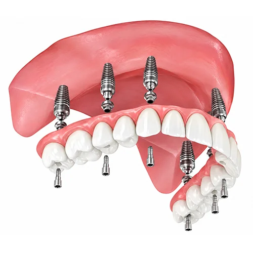 Illustration of a full-arch denture secured on All-on-X implants