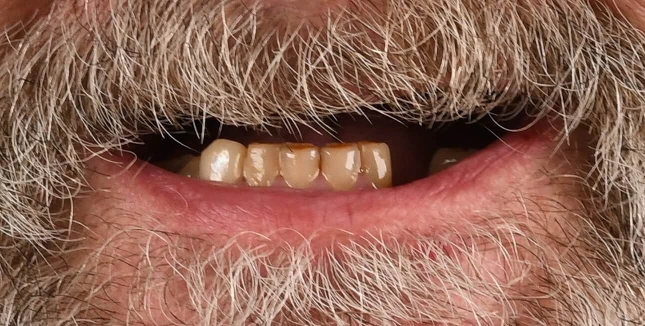 Donald before Upper All-on-X implant treatment with Dr. Constantine