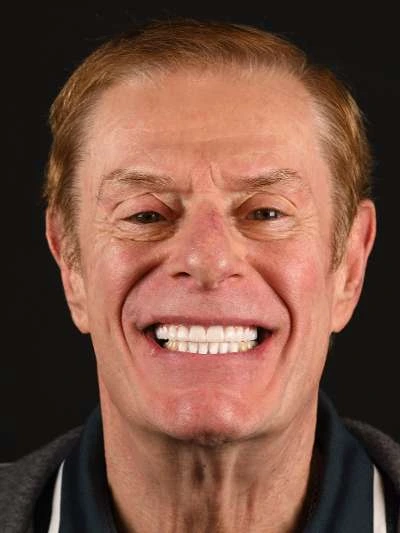 Patient smiling after All-on-X implant rehabilitation