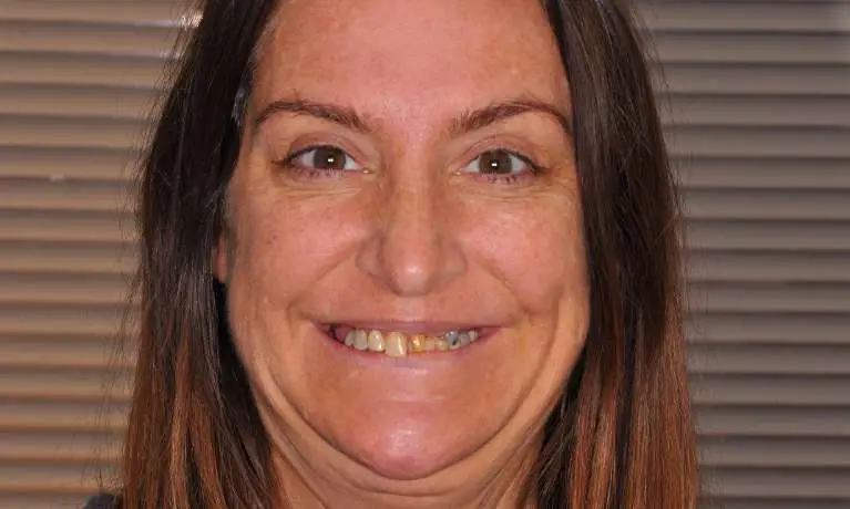Upper teeth before All-on-X implant rehabilitation