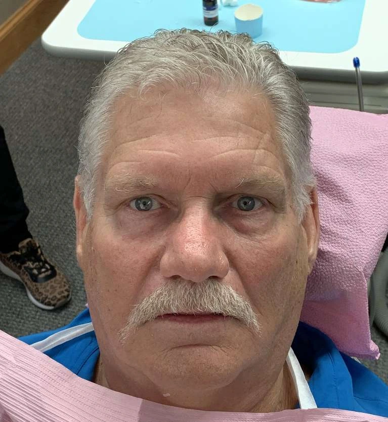 Patient smiling before upper complete implant rehabilitation