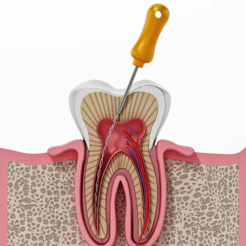 Cross-section illustration of a tooth with an endodontic file cleaning the infected pulp