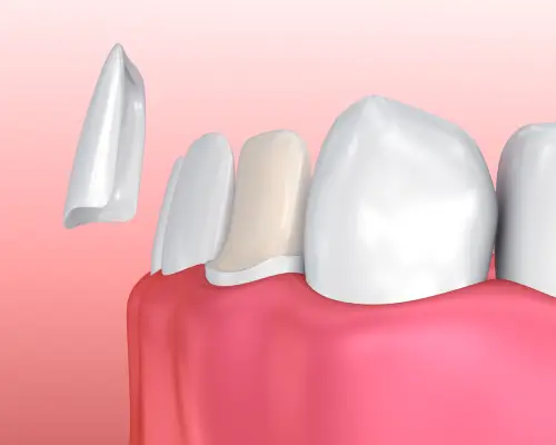 Illustration of a porcelain veneer being placed on the front of a tooth