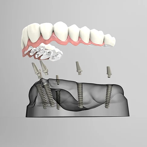 Illustration of a full-arch denture secured on four dental implants