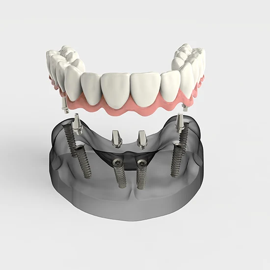 3D model of a full lower arch of teeth above implant posts in the jawbone