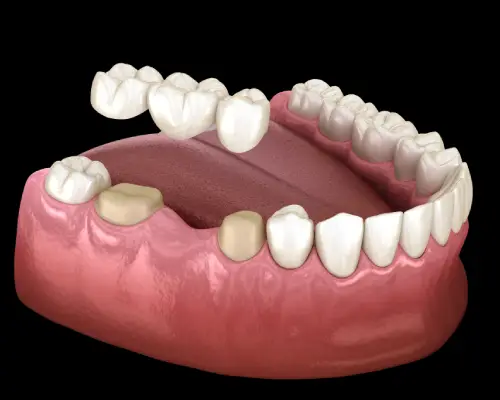 Illustration of a three-unit dental bridge being placed over two prepared teeth