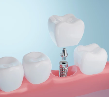 Illustration of a narrow mini dental implant post in the jaw