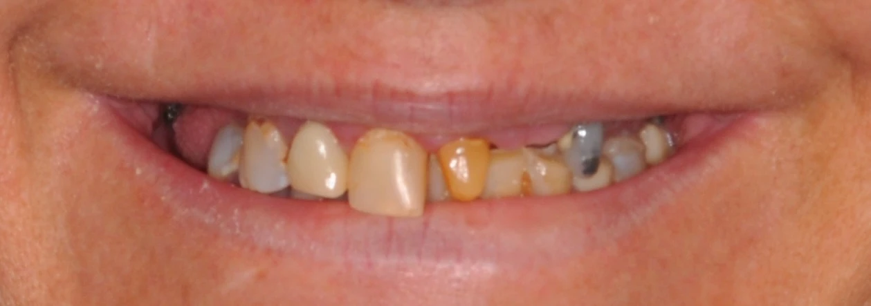 Shelby before All-on-X implant treatment with Dr. Constantine