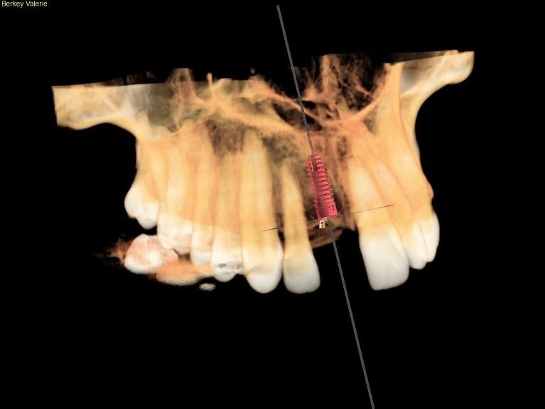 3-D cone beam imaging scan of the teeth and jaw